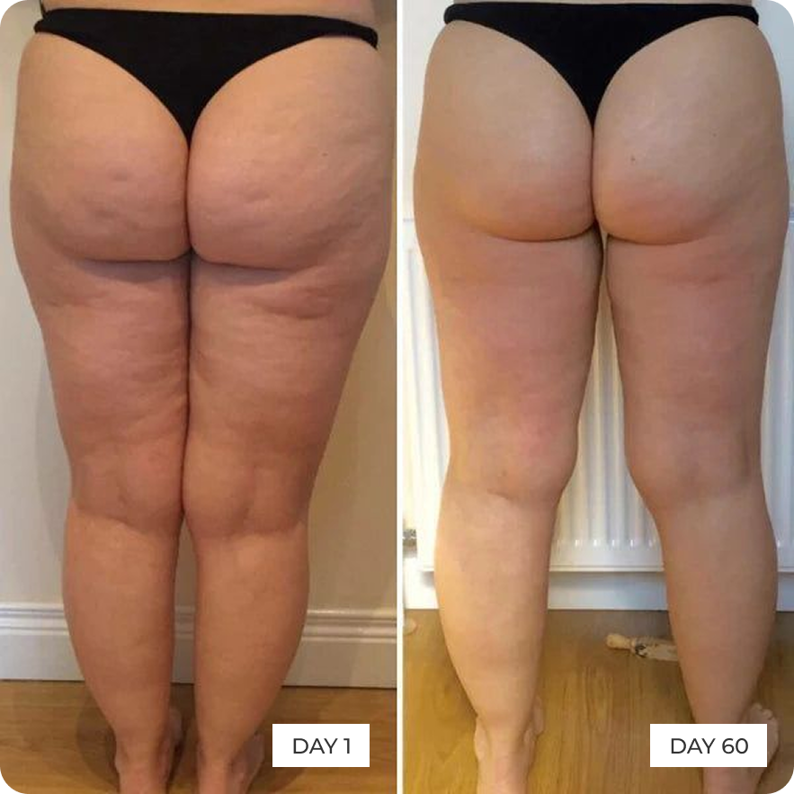 Before and after results on thighs and buttocks