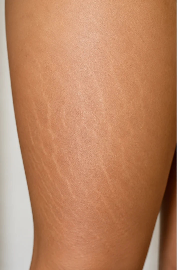 Thigh with visible stretch marks before use