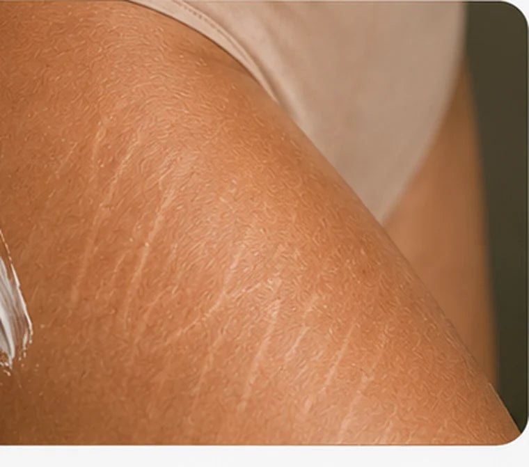 Applying cream to stretch marks